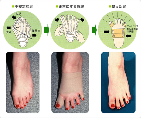 三郷市で外反母趾にお悩みの方は つるみ治療院にお任せください つるみ治療院併設ドリームアゲイン 埼玉県三郷市